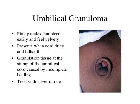 Granuloma In Belly Button