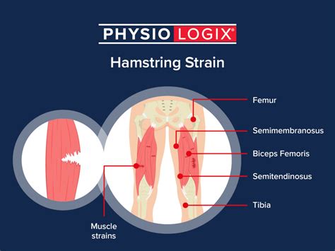 Hamstring Injury Muscle Pull Muscle Pull