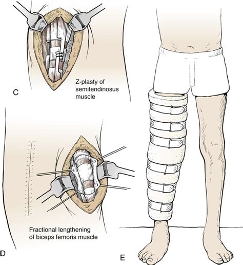 Hamstring Lengthening Surgery