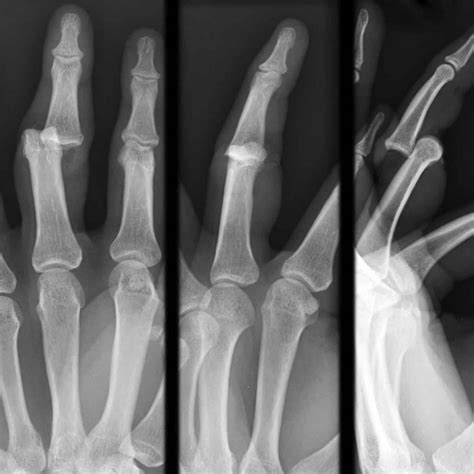 Hand Dislocation Causes Symptoms Diagnosis Treatment Prognosis