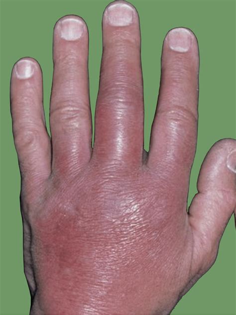 Hand Infections