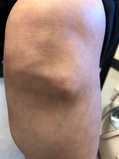 Hard Bump On Kneecap