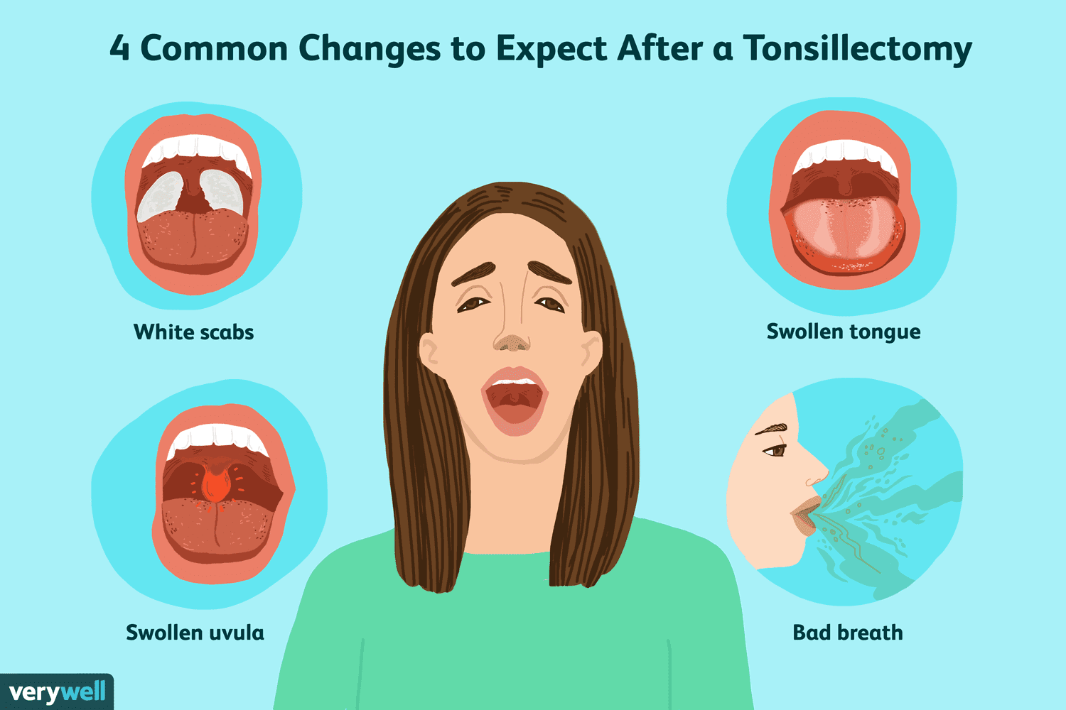 Healing From Tonsillectomy: Easy Pain Relief