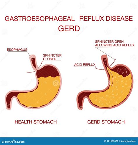 Heartburn And Gastroesophageal Reflux Disease Gerd Concept Health Stock