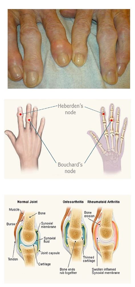 Heberden S Nodes Images Osteoarthritis Bone And Joint Synovial Fluid