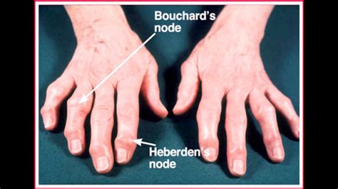 Heberden's And Bouchard's Nodes