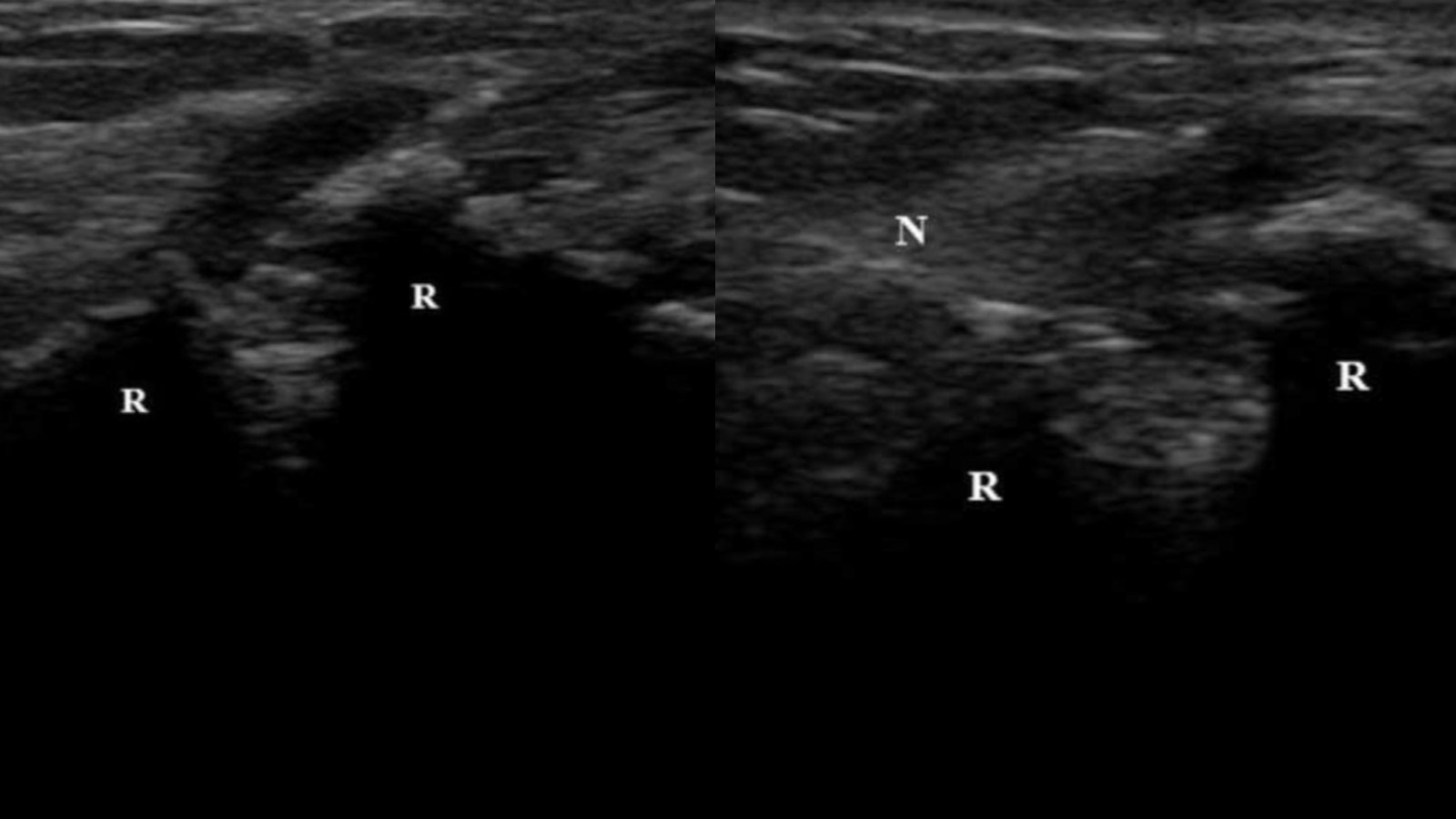 Hematoma Block Internet Book Of Msk Ultrasound