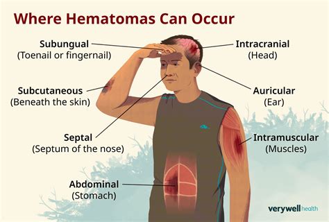 Hematoma Ice Or Heat