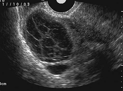 Hemorrhagic Cyst 38 Year Old Woman With A 5 Cm Multiloculated Cyst