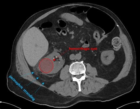 Hemorrhagic Renal Cyst