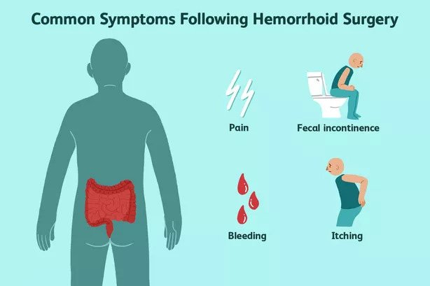 Hemorrhoid Surgery Care: Reduce Pain & Complications