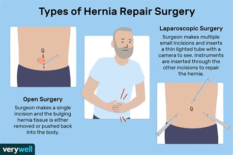 Hernia Post Op Recovery