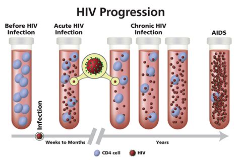 Hiv Progression: Manage Symptoms