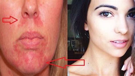 Home Remedies For Perioral Dermatitis Red Bumps Around The Mouth