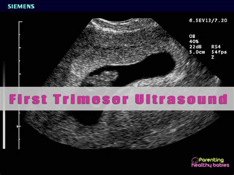 How Accurate Are First Trimester Dating Ultrasounds Telegraph