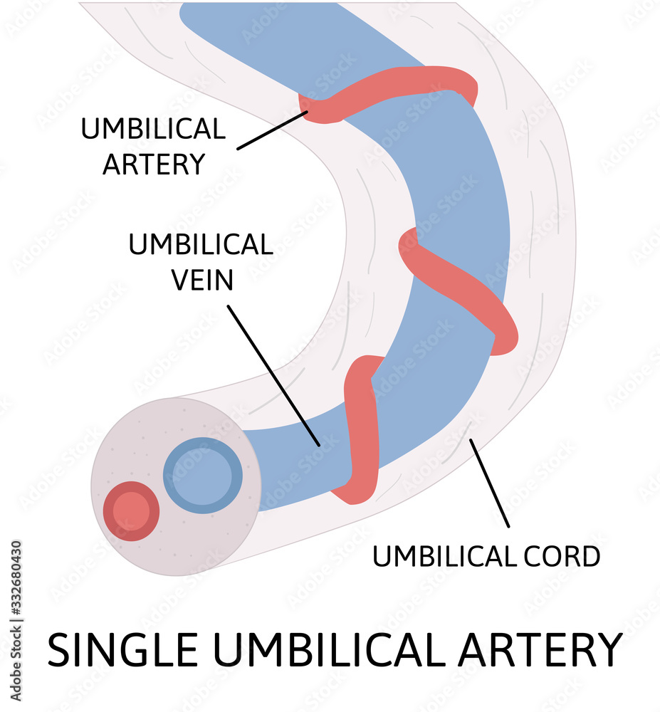 How Common Is Single Artery Umbilical Cord? Know Signs