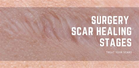 How Do Stitches Heal Scars A Comprehensive Guide To Recovery