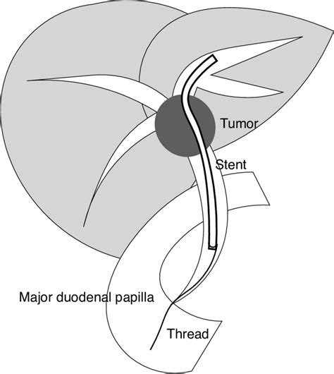 How Does Bowel Duct Stent Work? Solution Inside