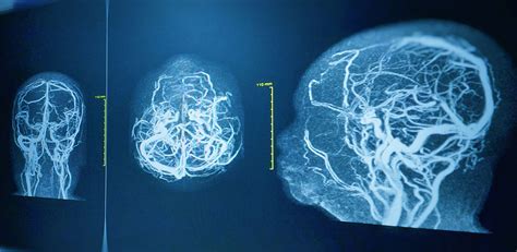 How Does Brain Angiogram Work? Accurate Results