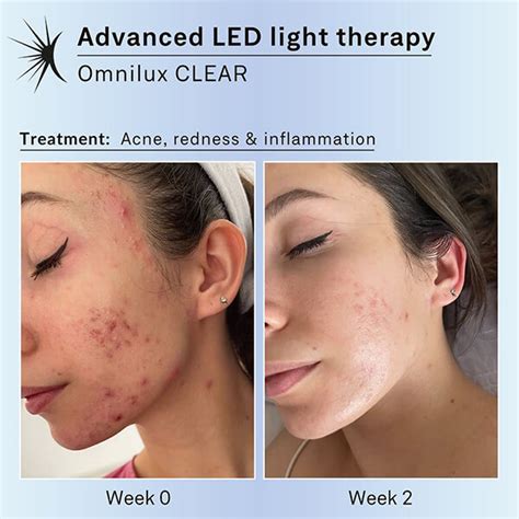 How Does Led Light Mask Work? Acne Fix