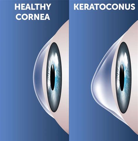 How Does Lens Compare To Cornea? Eye Health Tips