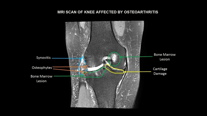 How Does Mri Knee Work? Get Answers