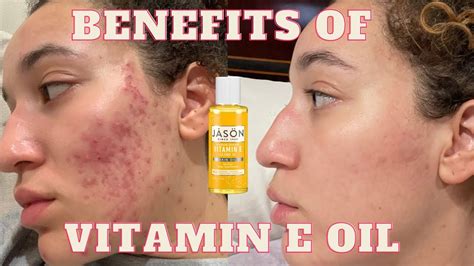 How Does Vitamin E And A Oil Help Acne?