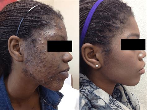 How Does Yale Dermatology Treat Acne? Effective Solutions