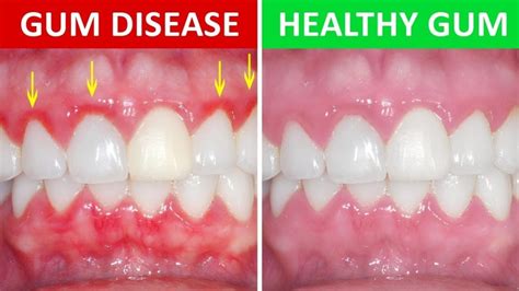 How Fatal Is Gum Disease? Know The Risks