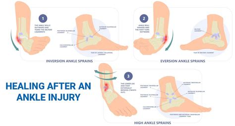 How Long Physio Takes? Ankle Injury Relief