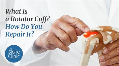 How Long Rotator Cuff Scar Lasts? Recovery Guide