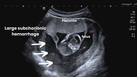 How Serious Is Subchorionic Hematoma On Ultrasound?