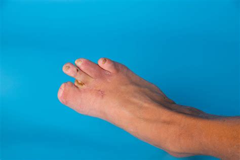 How To Cope With Big Toe Amputated? Pain Relief Solutions