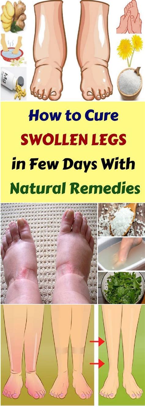 How To Cure Swollen Legs In Few Days Natural Remedy All What You