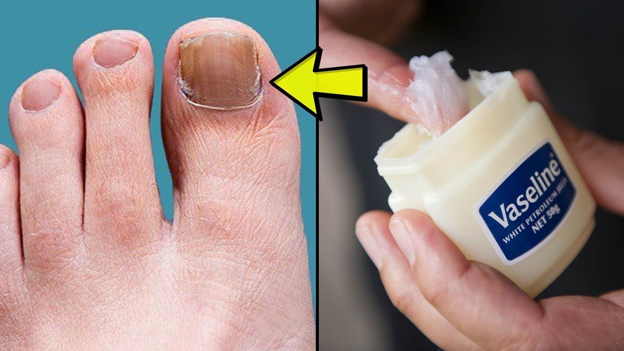 How To Cure Toenail Fungus In 3 Days Toenail Fungus Treatment Home