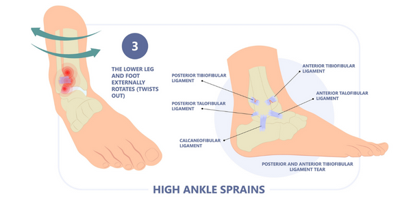 How To Deal With An Ankle Sprain Shellharbour Physiotherapy