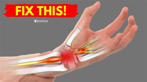 How To Do Wrist Rehab? Reduce Pain Now