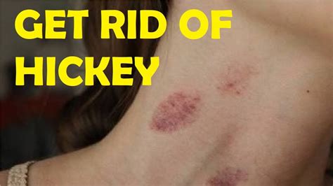 How To Get Rid Of A Hickey In Two Minutes Youtube