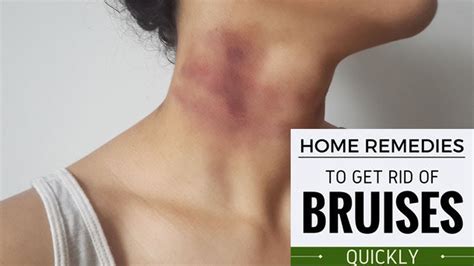 How To Get Rid Of Bruises Fast With Home Remedies Home Remedies For