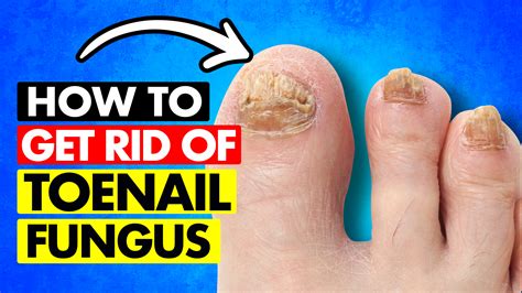 How To Get Rid Of Fungus Toenails Naturally At Wilma Sharp Blog