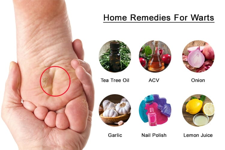 How To Get Rid Of Plantar Warts On Foot Naturally Best Home Remedies