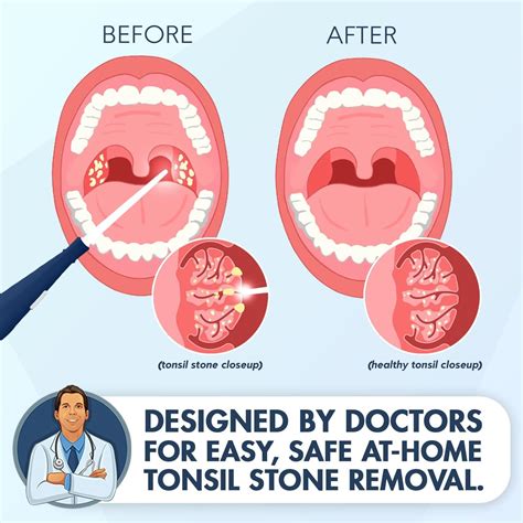 How To Get Rid Of Tonsil Stones