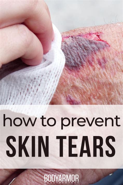 How To Heal Tear Of The Skin? Simple Remedies