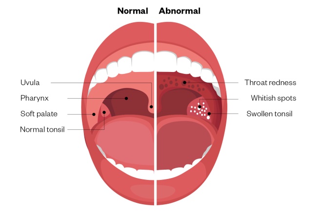 How To Identify Normal Throat Pictures? Check Symptoms