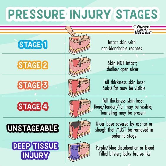 How To Identify Pressure Injury Stages? Prevention Tips