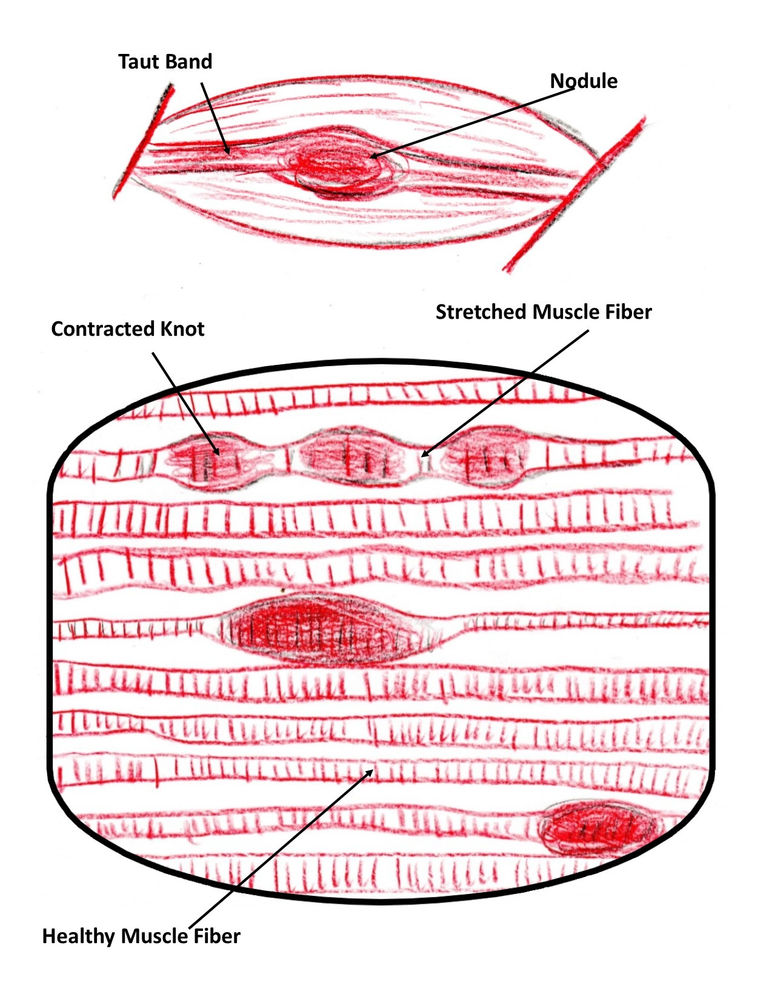 How To Identify Real Pictures Of Muscle Knots