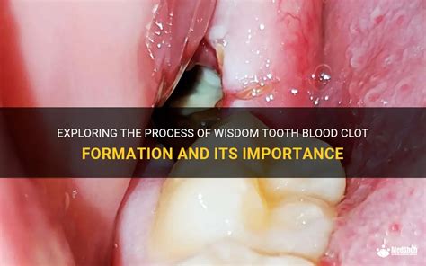 How To Keep Wisdom Tooth Clot Intact?