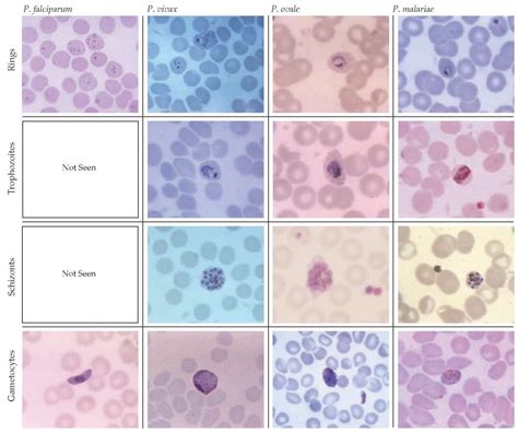 How To Read Malaria Blood Smear? Easy Detection