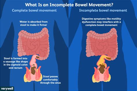 How To Reduce Symptoms Of Incomplete Defecation Sigmoid Colon Bowel