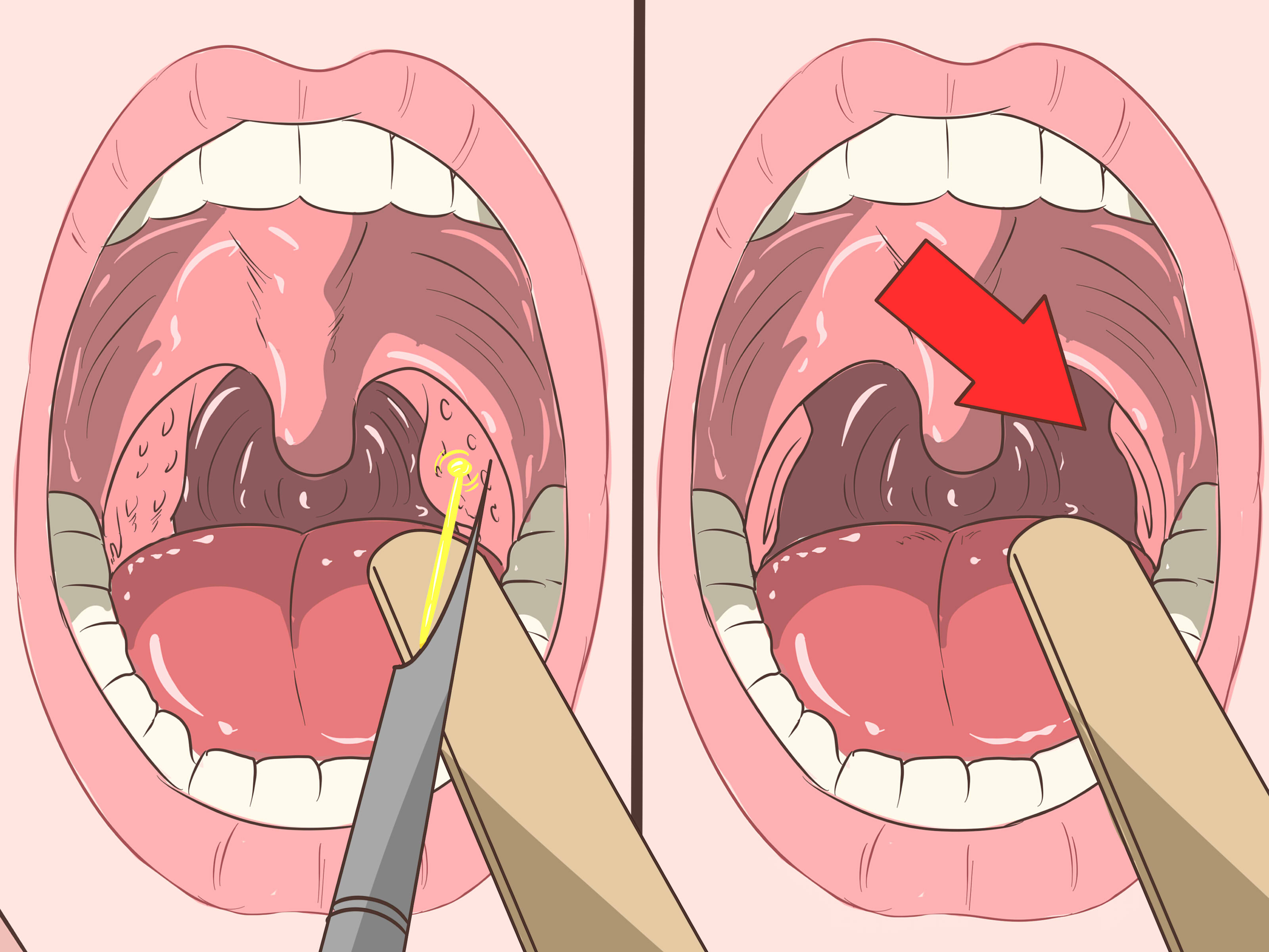 How To Remove Tonsil Stones? Quick Fix